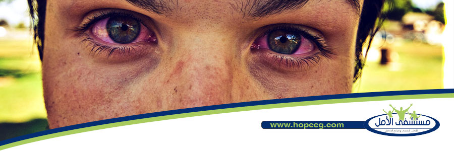 آثار الحشيش على الوجه تبدأ من احمرار العين 